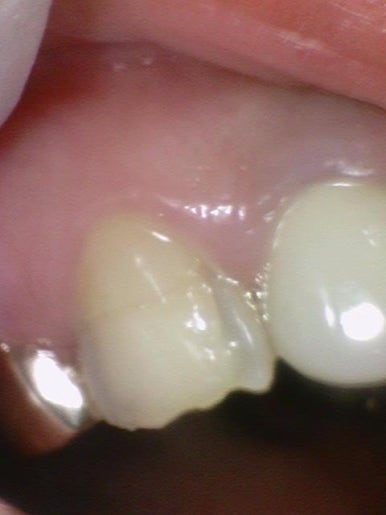 [시청역/광화문] 부식된 노란치아. 정말 하얀, 새하얀 치아로 만들고 싶어요 비용도 알려드려요 관련 이미지 7