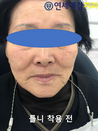 남대문시장가까운치과, 명동,서울역&용산가까운치과, 틀니치료 사례 관련 이미지 6