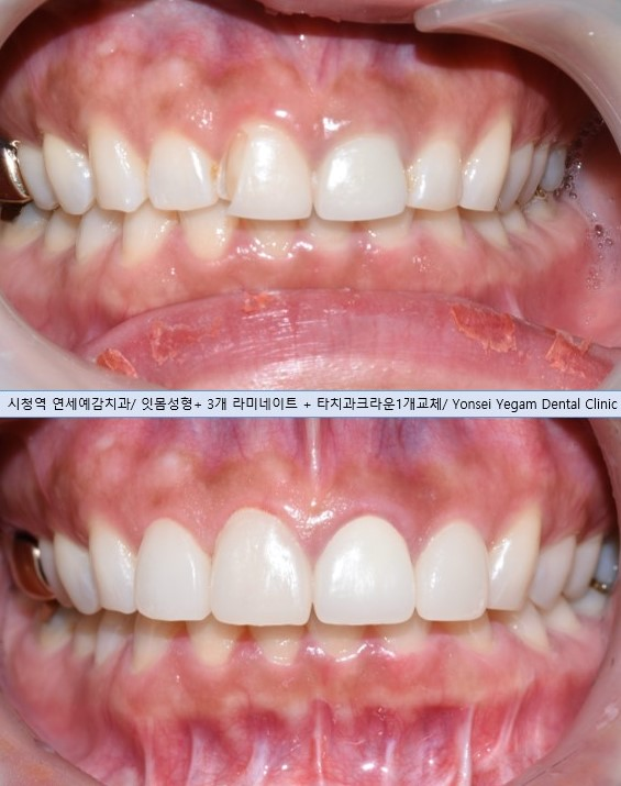 VENEER in Seoul, Korea/ Cost, Cases(before&after photos)/ YONSEI YEGAM DENTAL CLINIC 관련 이미지 4