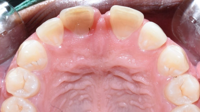 명동 가까운 치과 /외국인 흑인분의 매우 벌어진 앞니 치료 (빠른 부분교정(3개월)+라미네이트)/가격안내 관련 이미지 5