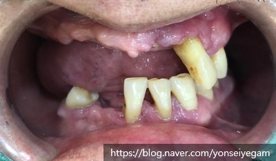 시청역,광화문 직장인에게 필요한 빠른 임플란트! 수술이 무서운 어르신들에게 만족도 높은 임플란트! 관련 이미지 7