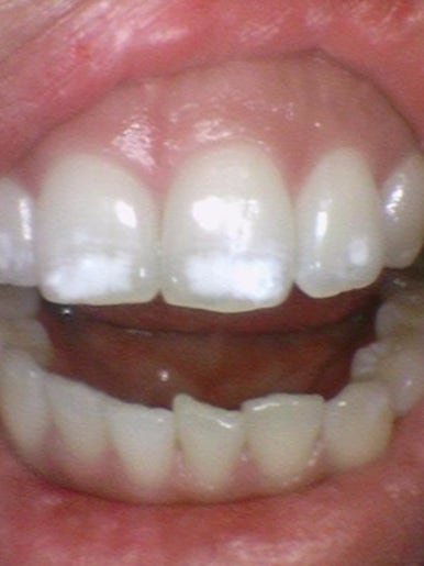 [서울 광화문/남대문] 화이트스팟 레진으로 치료케이스, 비용안내 등등 / 반점치, 반상치 관련 이미지 8