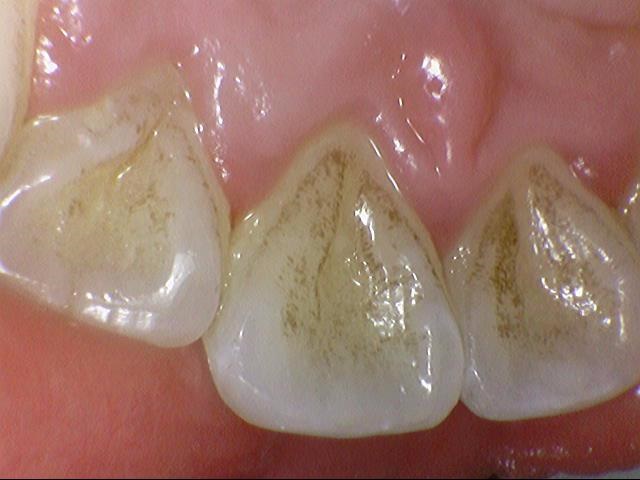 서울시청역 앞니 치아에 갈색 점, 흰색점 치료 전후 관련 이미지 2