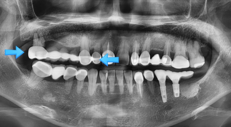 [시청역/서울역]네비게이션인플란트를 이용한 여러개 임플란트 과정 관련 이미지 1