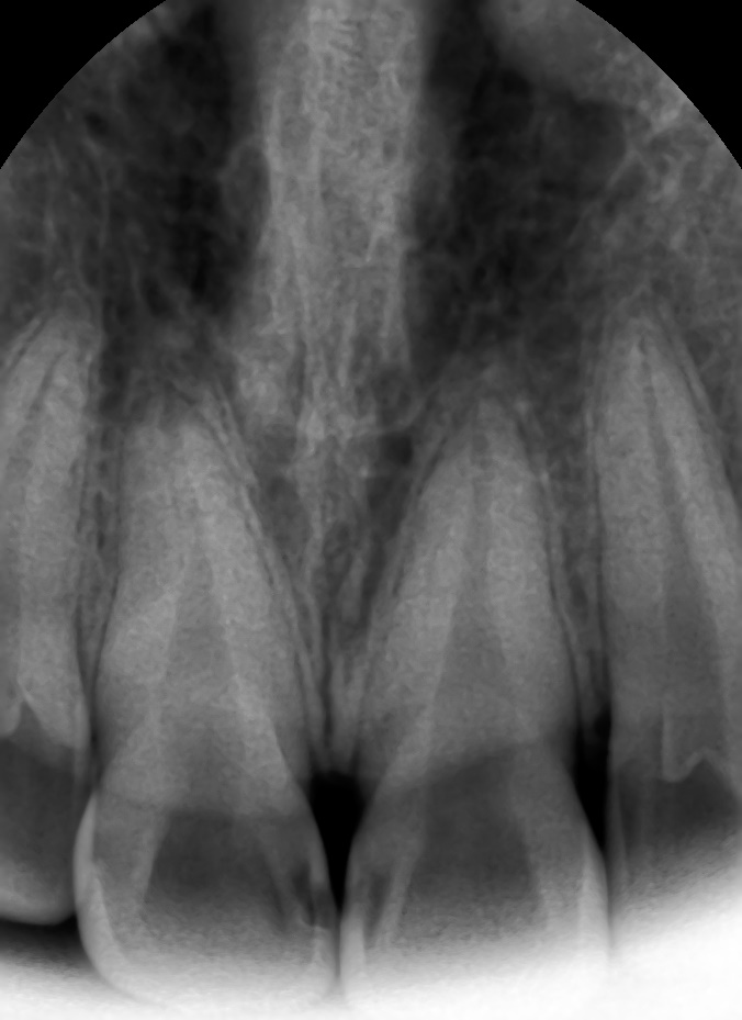 앞니충치가 너무 심해요 앞니 충치치료 방법 [시청역서울역 치과] 관련 이미지 5