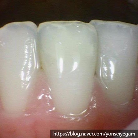 [서울역/시청역] 레진치료 : 화이트스팟(반상치) 케이스 & 치아패임으로 시린 케이스 & 깨진 치아 케이스 관련 이미지 6