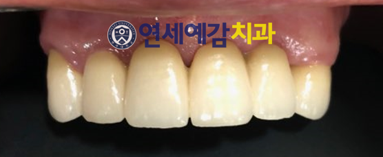 서울 틀니제작, 틀니치료 실제 예입니다. 시청역<연세예감치과> 관련 이미지 10