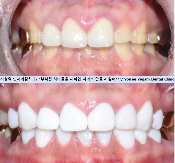 [시청역/광화문] 부식된 노란치아. 정말 하얀, 새하얀 치아로 만들고 싶어요 비용도 알려드려요 관련 이미지 1