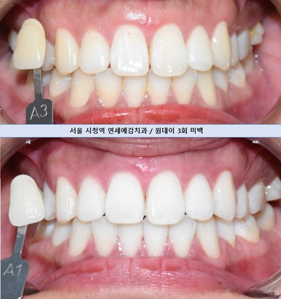 소개팅준비? 결혼 준비? 외국,해외에서도 찾아오는 치아미백 치과! 관련 이미지 14