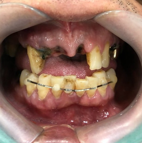 [시청역/서울역 치과] 앞니 치아부러짐 자연스럽게 치료사례 관련 이미지 8