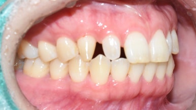 서울 시청역/서울역/ 벌어진 앞니, 왜소치 라미네이트 유명한 치과/ 전후 비교와 가격 관련 이미지 5