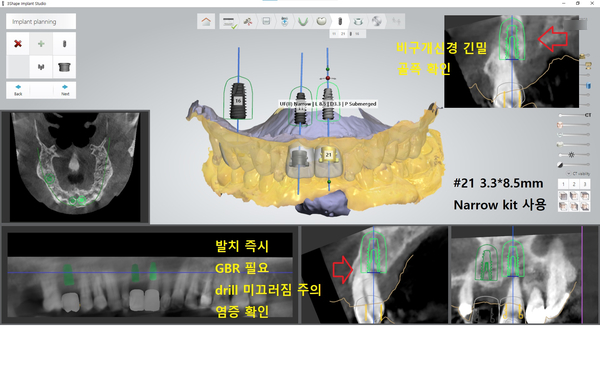 [서울시청역/서울역] 앞니 임플란트 가능할까요? 앞니 내비게이션임플란트 관련 이미지 8