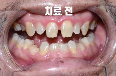 외국인환자의 왜소치 및 치아사이 공간으로 인한 서울 무삭제 라미네이트 & 최소삭제라미네이트 6개 케이스 치아전후사진 이벤트비용 관련 이미지 1