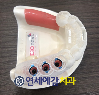 시청역 연세예감치과 디지털임플란트우수시술병원 선정 & 네비게이션 임플란트 관련 이미지 8