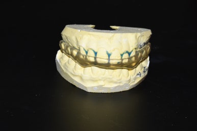 [서울/시청역] 이갈이소리녹음,이갈이장치소개, 이갈이치료방법, 가격 관련 이미지 5