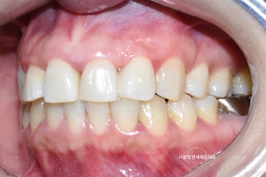 (교정 후에도) 벌어진 앞니 치아 레진으로 간단히 메꾸기 관련 이미지 3