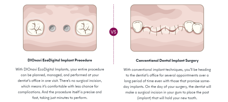 Navigation Dental Implant in Seoul, Korea. 관련 이미지 21