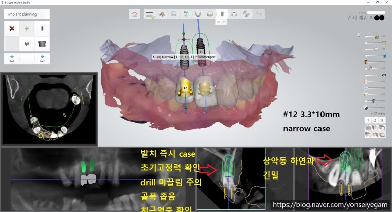 서울역 가까운 치과 시청역치과 연세예감 임플란트 네비게이션임플란트로 다수 임플란트도 빠른수술과 부작용최소화 관련 이미지 4