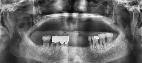 [남대문] 치과임플란트 조금더 덜아프고, 간단하게! 관련 이미지 4