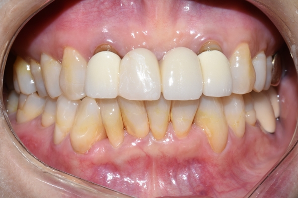 [치과브릿지]남대문치과/깨지고 오래된 앞니브릿지 교체케이스 관련 이미지 3