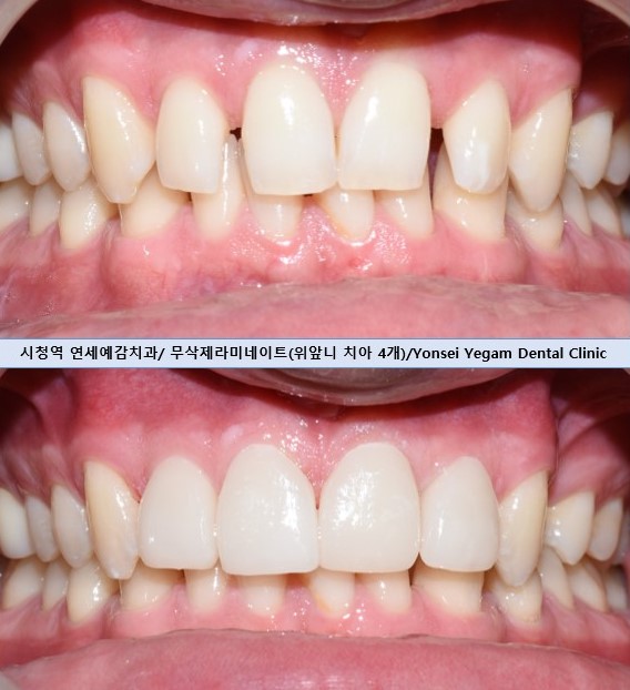 서울시청역치과/ 벌어진 앞니 치아 치료/ 왜소치, 다이아스테마 등/레진, 라미네이트, 부분교정 비교 관련 이미지 19