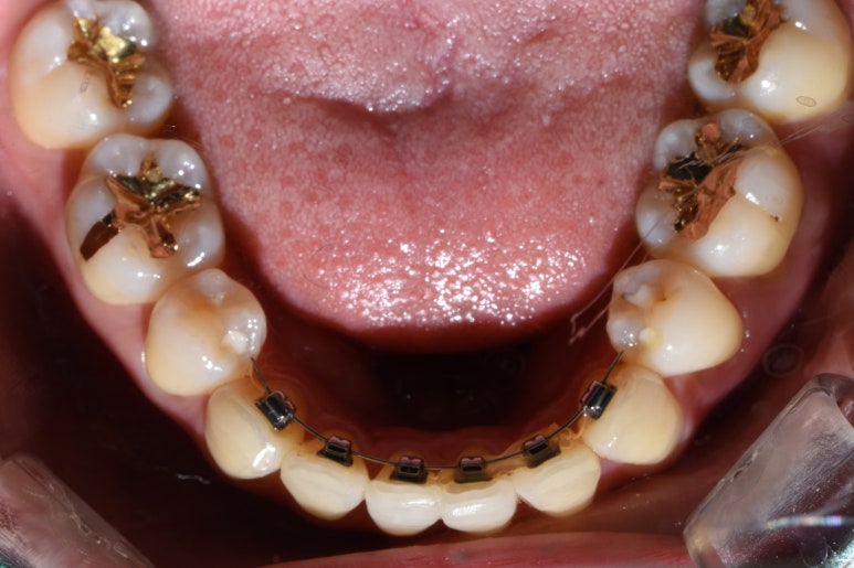 [시청역] 마스크를 벗을 그때를 대비한 이벤트! 치아미백/보톡스/라미네이트/앞니부분교정 이벤트가 안내 관련 이미지 6