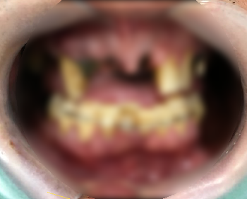 이가 빠졌어요. 이 빠진 환자 보철 환자 케이스 소개 <시청역 연세예감치과> 관련 이미지 6