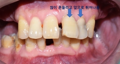 [치과브릿지케이스] 앞니가 너무 많이 흔들려서 발치해야 할 것 같아요 관련 이미지 1