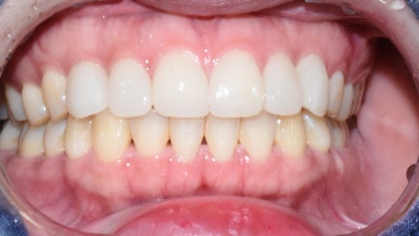 서울 시청역/서울역/ 벌어진 앞니, 왜소치 라미네이트 유명한 치과/ 전후 비교와 가격 관련 이미지 9