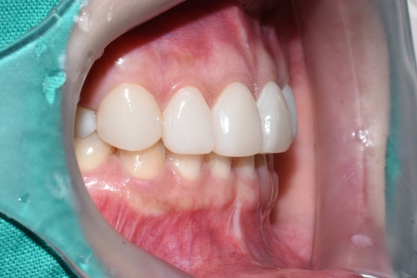 [시청역/광화문]옥니 무삭제라미네이트 전후 소개 및 이벤트 가격안내 관련 이미지 5