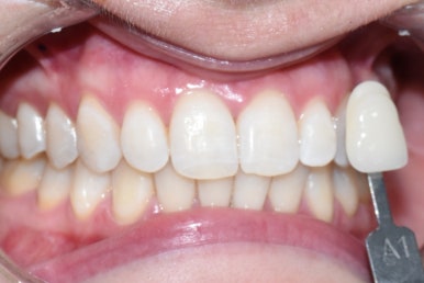 치아미백, 치과에서 하면 얼마나 오래갈까? 궁금하시다면, 실제사례 바탕으로 알아보아요 지속,유지 관련 이미지 6