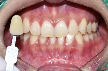 [서울시청역/광화문]치과에서 하는 원데이 치아미백, 연세예감치과에서 알려드려요 관련 이미지 2