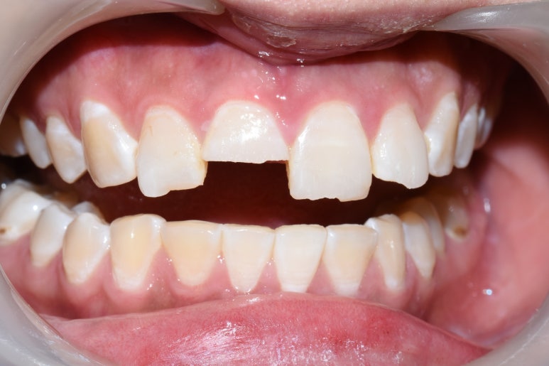 [서대문가까운/치과] 깨진 치아 레진 떼운 사례 관련 이미지 5