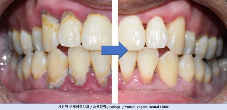11월, 연말전에 꼭 해야할 일, 왜 스케일링을 빨리 해야하는지 알려드립니다 관련 이미지 1
