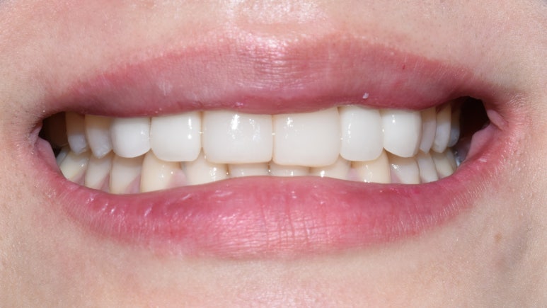 [광화문/시청역 치과]임플란트+크라운 +무삭제 라미네이트 복합 혼합 "6개 앞니 케이스" 소개/라미네이트가격 관련 이미지 5