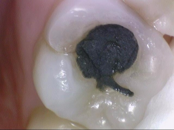 광화문/시청역"까만 아말감, 금니가 보기 싫다면?" 관련 이미지 7