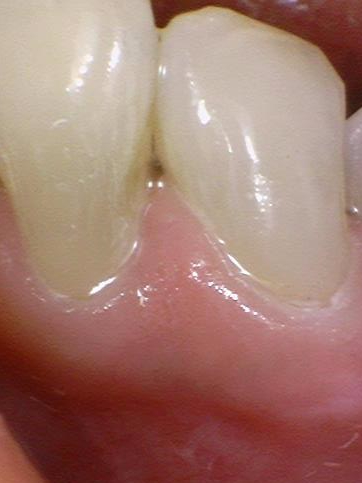 [을지로/명동 근처 치과] 앞니 레진 치료사례 관련 이미지 5