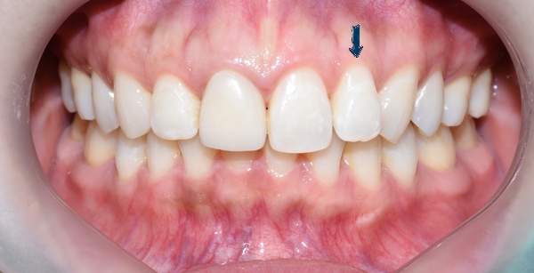 Q&A:"교정을 예전에 오래전에 했는데 앞니치아가 삐뚤어졌어요"해결방법은, 비용은? 관련 이미지 1