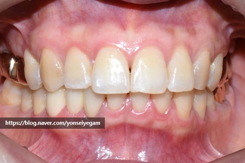 벌어진 앞니 교정치료 & 오래된 앞니 브릿지 다시하기 관련 이미지 11