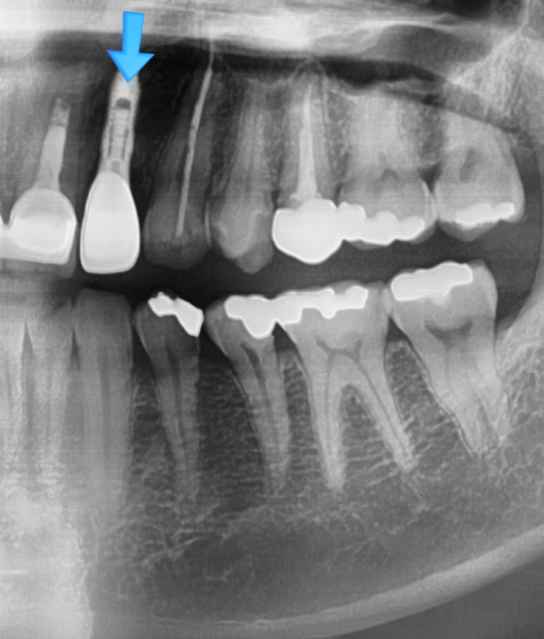 [시청역/서울역 치과] 앞니 치아부러짐 자연스럽게 치료사례 관련 이미지 14