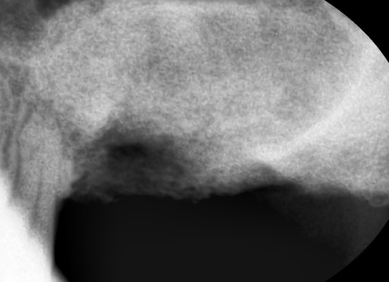 [서울시청역치과] 다른 치과에서 오래전에 한 임플란트가 흔들려요 &rarr;재수술 케이스 관련 이미지 8