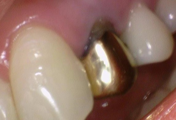 [서울역/광화문] 오래된 크라운에 음식물이 많이 껴요 &rarr;해결방법은? 관련 이미지 3