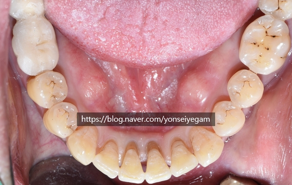 시청역 앞니교정 알아보겠습니다![실제 사례:앞니 하나가 점점 튀어나오고 벌어져요] 관련 이미지 3