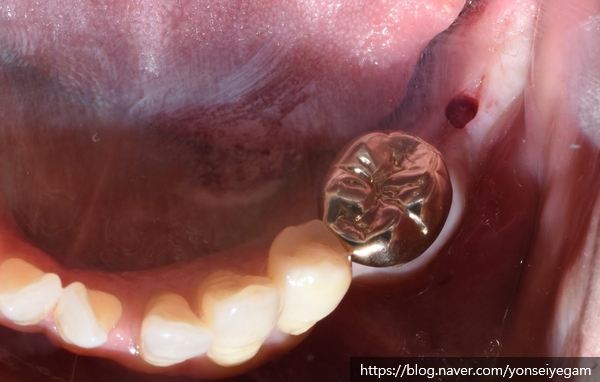 [북창동 치과/연세예감치과]내비게이션임플란트소개 관련 이미지 3