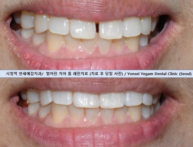 치아 앞니 벌어짐 벌어진 앞니&rarr;레진치료 비용까지 알려드려요 관련 이미지 3