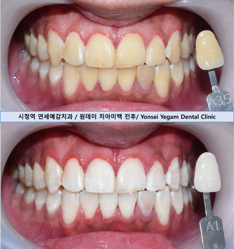 City Hall Station One-Day Teeth Whitening: The Dental Clinic with the Most Whitening Sessions in Jung-gu, Including Costs and Prices—Teeth Whitening for Wedding Preparation image 1