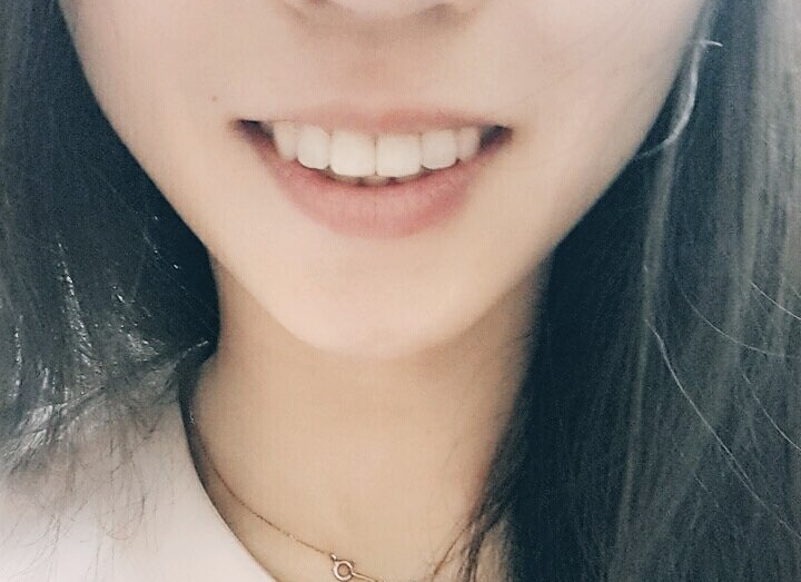 시청역치과 연세예감치과의 2번만의 내원으로 완성되는 고른앞니 만들기 케이스 소개 관련 이미지 6