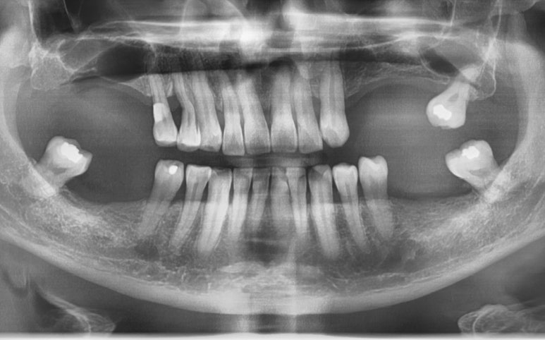 [서울역/치과] 고기 뼈를 씹고 치아가 부러졌어요 관련 이미지 1