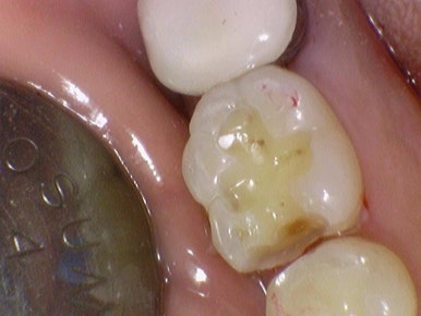 충정로 치과 인레이 해야한다고 들었는데 충치가 안보여요 관련 이미지 14