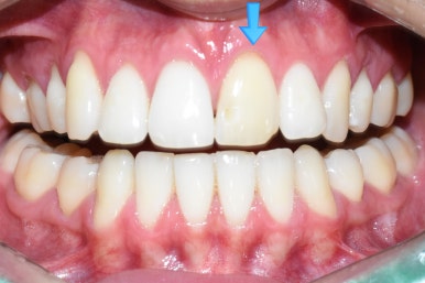 [광화문/치과] 외국인환자 변색된 앞니 하나의 크라운 치료 실제 케이스 관련 이미지 1